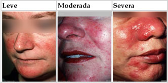 galderma_rosacea